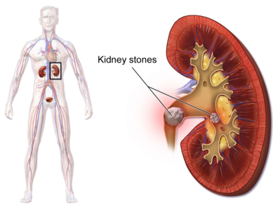 Does Lack Of Enzymes Causes Kidney Stones? Symptoms, Prevention And Causes Explored