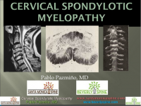 Cervical Myelopathy Physiopedia