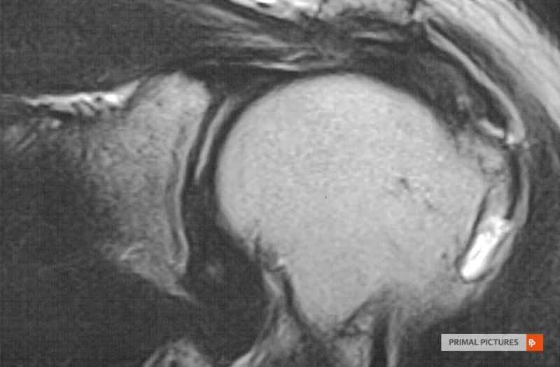 File:Tear of supraspinatus tendon.png