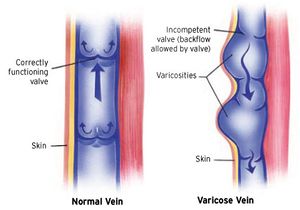 Chronic Venous Insufficiency and Varicose Veins