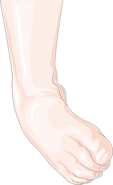 File:Ankle sprain.png