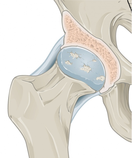 File:Osteoarthritis in the Hip.jpg