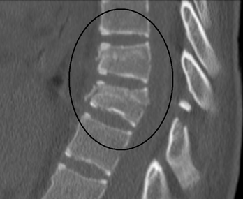TLSO Thoracic Back Brace | Mild Scoliosis, Spinal Trauma, Osteoporosis
