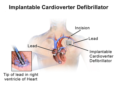 ImplantableCardioverterDefibrillator InsideLeads.png