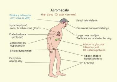 acromegaly before and after