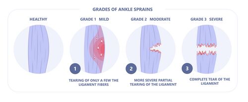 Two common types of ankle sprain (inversion and eversion) Stock