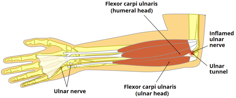 File:Cubital-Tunnel-Syndrome-Anatomy.png