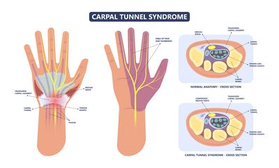 DB:LAB Wrist Splint Brace Night Sleep Support for Carpal Tunnel