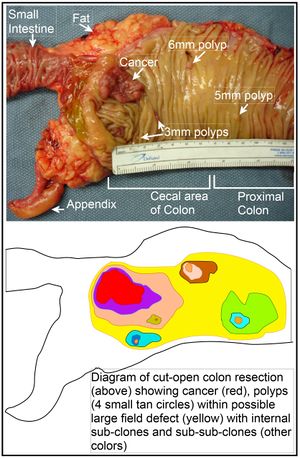Image of resected colon segment with cancer & 4 nearby polyps plus schematic of field defects with sub-clones.jpg