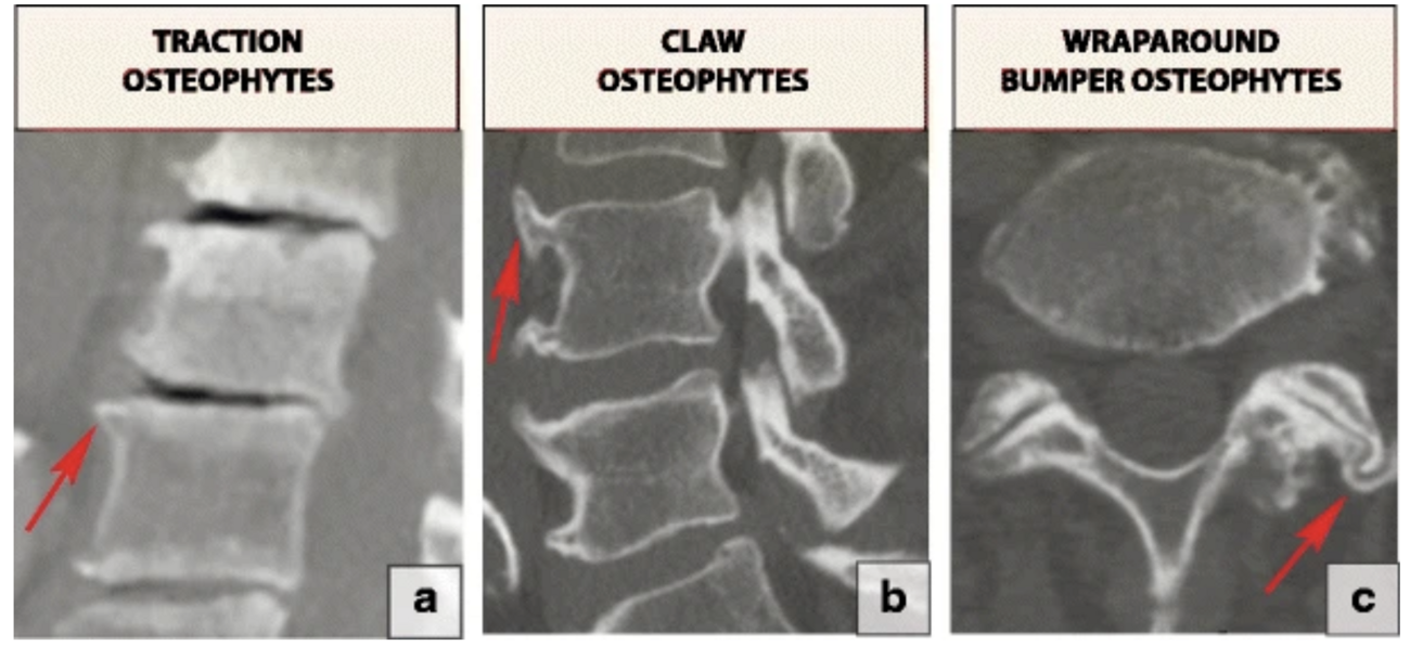 Osteophyte Physiopedia 5322