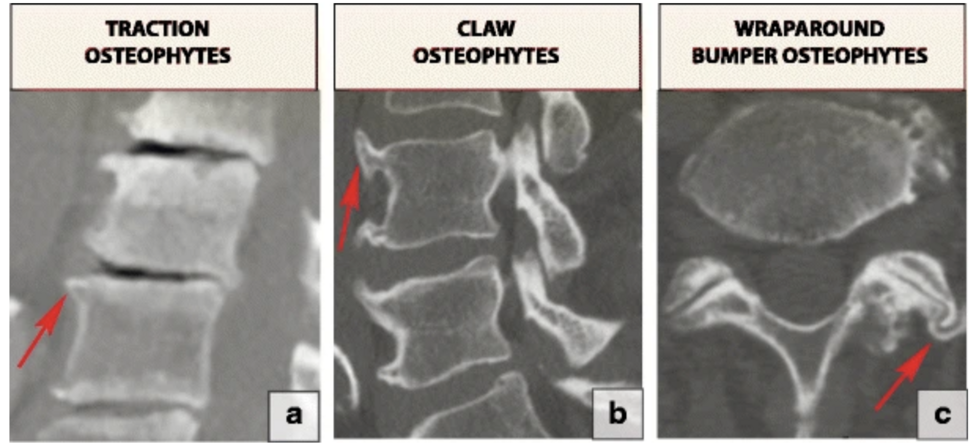 Osteophyte Physiopedia 3708