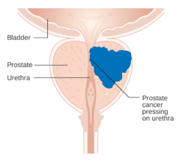 Diagram showing prostate cancer pressing on the urethra CRUK 182.svg.png