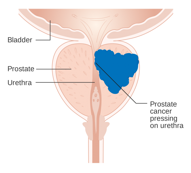 File:Diagram showing prostate cancer pressing on the urethra CRUK 182.svg.png