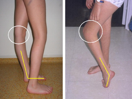 What is a weak flexion of the knee?