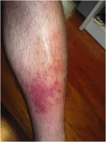 Cellulitis.png