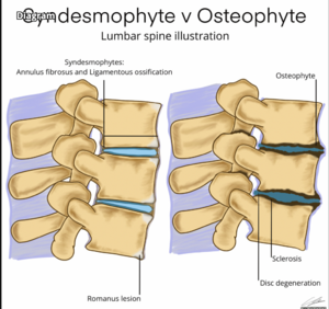 uncovertebral osteophytes
