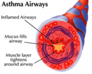 Asthma airways.png