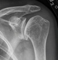 X-ray of osteoarthritis of the shoulder.jpg