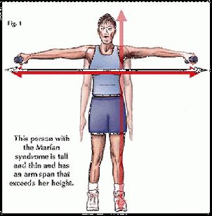 marfan syndrome phelps