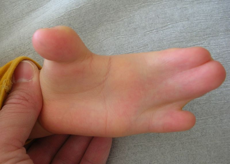 File:Congenital Hand in Apert Syndrome.JPG