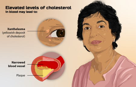 Przedstawienie osoby cierpiącej na wysoki poziom cholesterolu.png