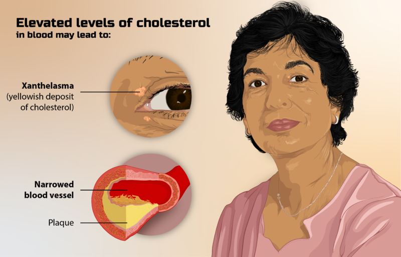 File:Depiction of a person suffering from high cholesterol.png