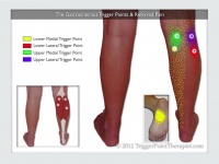 Gastrocnemius trigger points referred pain-1024x768.jpg