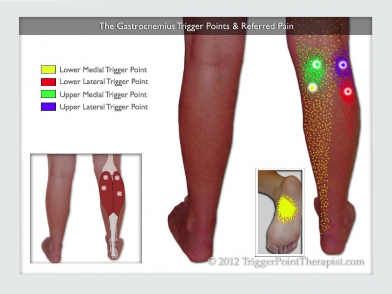 File:Gastrocnemius trigger points referred pain-1024x768.jpg