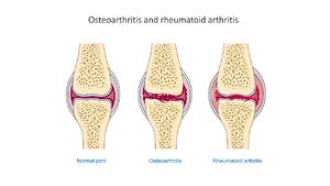 Arthritis, Definition, Causes, & Treatment