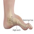 Hammer toe